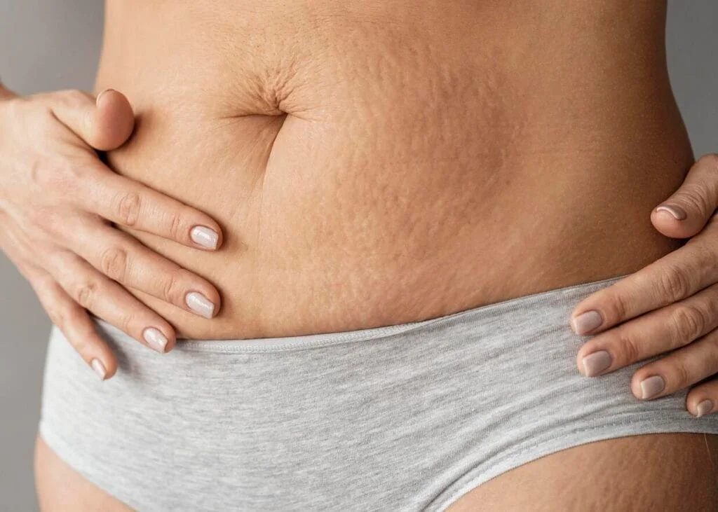 Perlu Diketahui, Perbedaan Stretch Mark dan Selulit