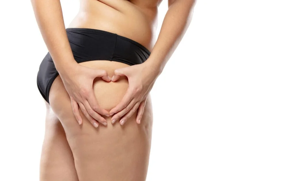 Selulit dan stretch mark